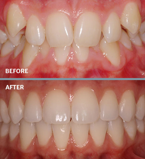 Before and after crowding braces