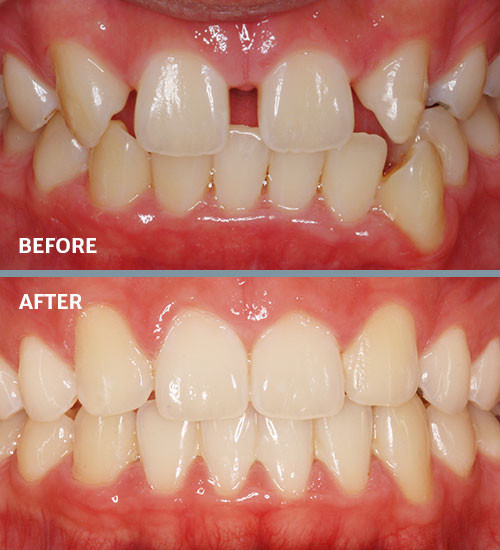 Spacing before and after missing teeth