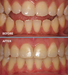 Jaw Surgery | Fruge Orthodontics