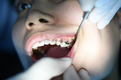 Braces Baton Rouge Orthodontist