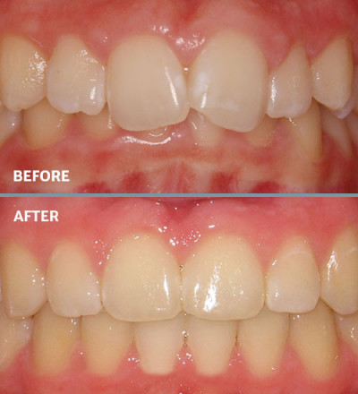Before and after overbite treatment
