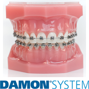 Damon braces are smaller than traditional braces