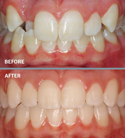 Before and after crossbite treatment