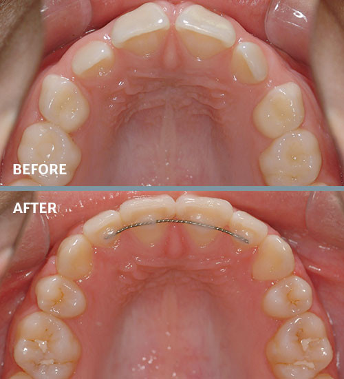 Spacing before and after braces
