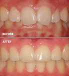 Overbite Before and After
