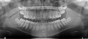 X-Rays - What are Orthodontic Records?