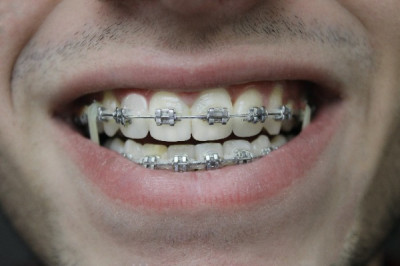 Adult Braces - What You Need to Know Baton Rouge Orthodontist