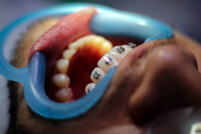 Parts of Braces | Baton Rouge Orthodontist