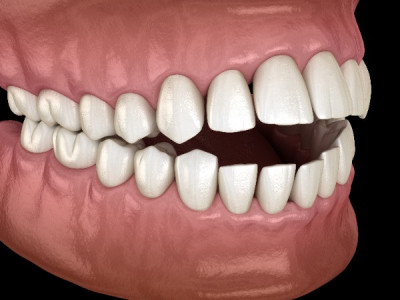 Open Bite - Orthodontist Baton Rouge Orthodontist