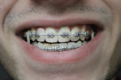 Pain During Braces Removal - Orthodontist Baton Rouge Orthodontist