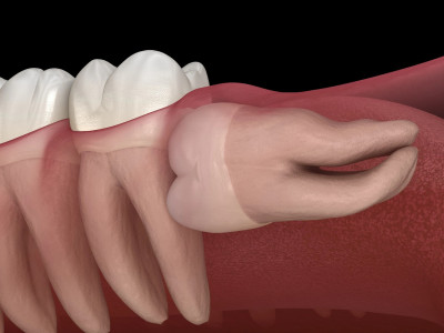 How Long After Wisdom Teeth Removal Can I Get Braces?