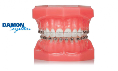 Damon Clear Brackets | Fruge Orthodontics